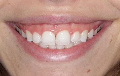 After: Gap between the front teeth closed. A patient of the practice.