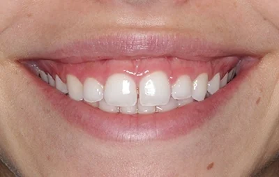 Before: Gap between the front teeth closed. A patient of the practice.