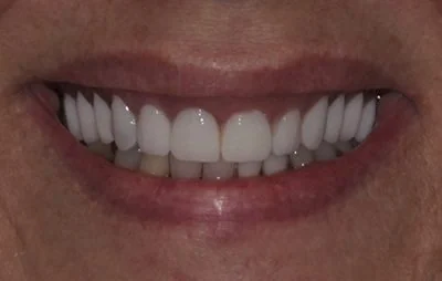 After: Smile makeover. A patient of the practice.