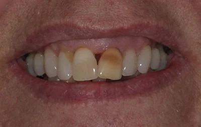 Before: Smile makeover. A patient of the practice.