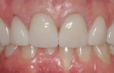 After: Front teeth, before and after. A patient of the practice.