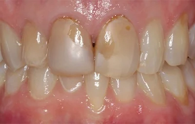 Before: Front teeth, before and after. A patient of the practice.