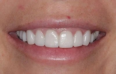 After: Upper teeth, before and after. A patient of the practice.