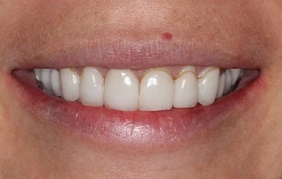 Before: Upper teeth, before and after. A patient of the practice.